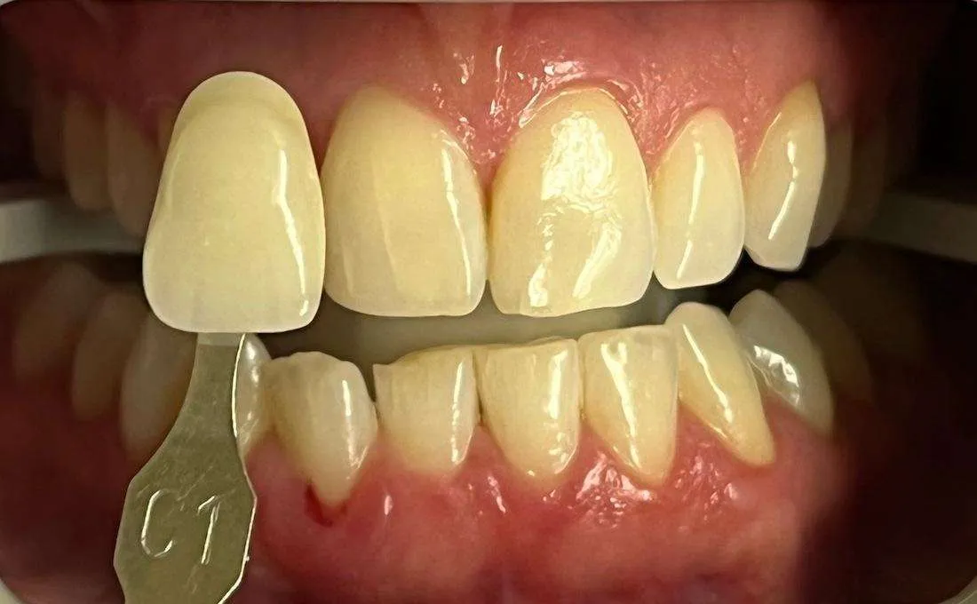 29034 professional teeth whitening