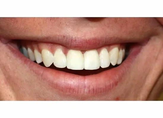 /img/29034-teeth-whitening-maintenance.webp