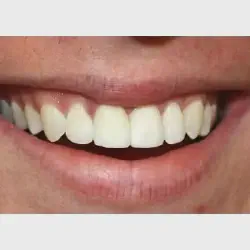 /img/29034-teeth-whitening-maintenance.webp