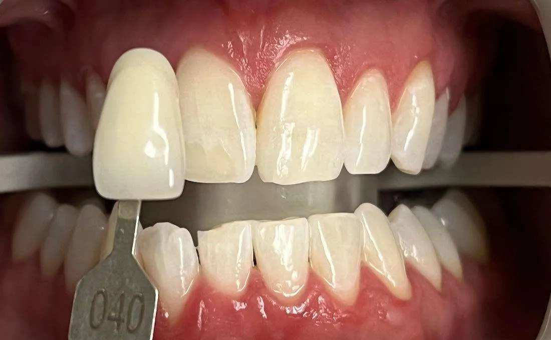 29034 teeth whitening maple grove mn consultation