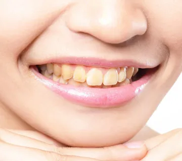 29034 teeth whitening procedure
