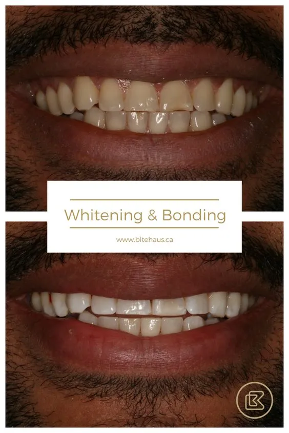 29037 dentist consultation teeth whitening