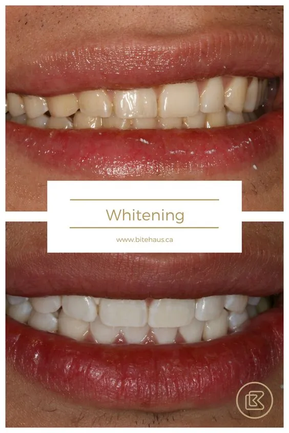 29037 oral hygiene teeth whitening