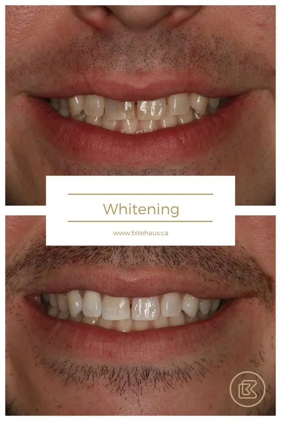 /img/29037-teeth-whitening-results.webp