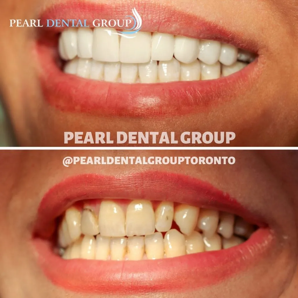 29037 teeth whitening treatment