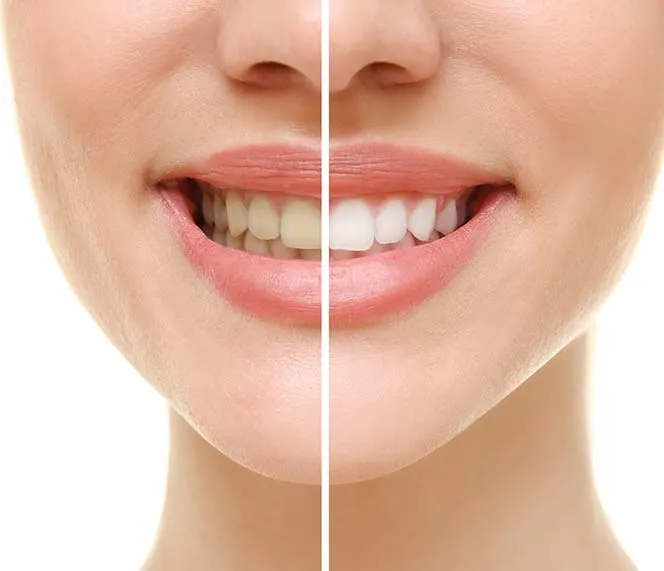 29040 in office teeth whitening