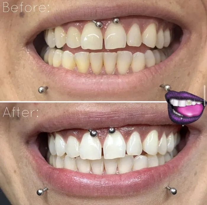 29040 teeth discoloration causes