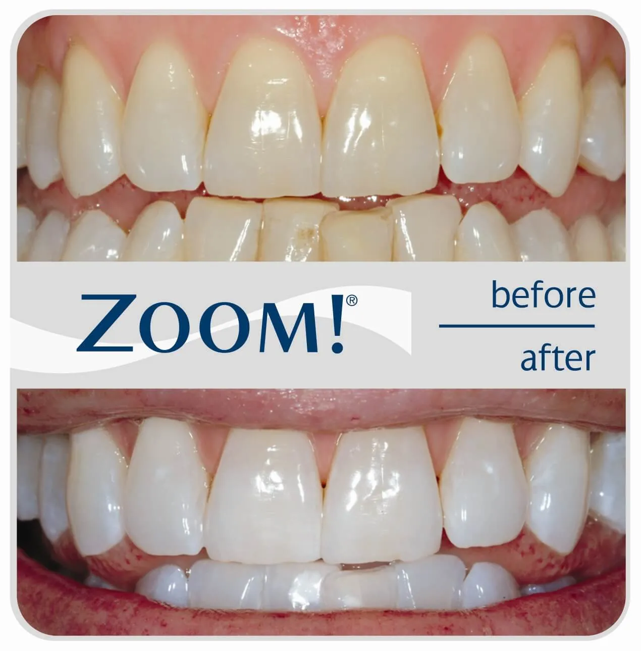 29047 zoom teeth whitening at home 3