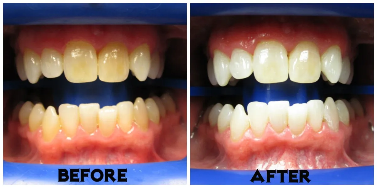 29047 zoom teeth whitening at home 5