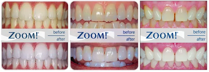 29047 zoom teeth whitening at home 6