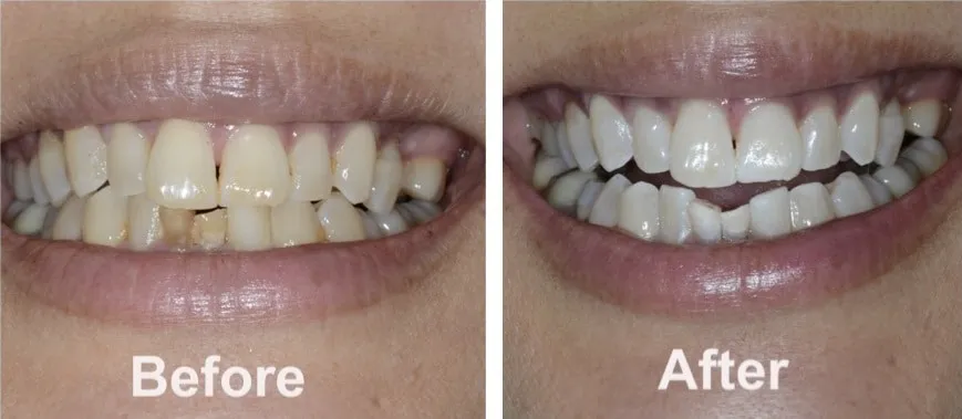 /img/29047-zoom-teeth-whitening-at-home-7.webp