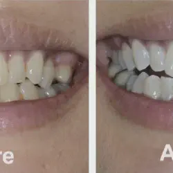 /img/29047-zoom-teeth-whitening-at-home-7.webp