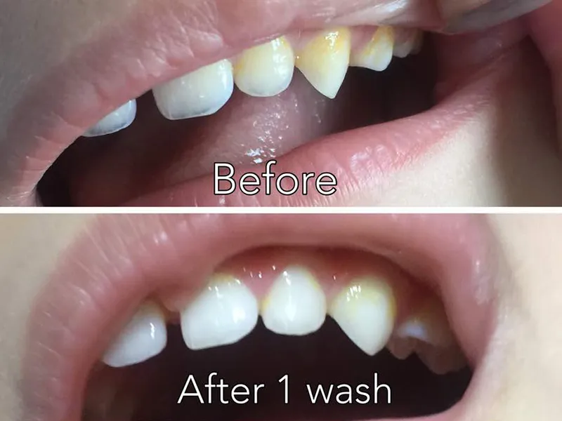 29049 teen whitening risks