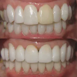 /img/29051-before-after-teeth.webp