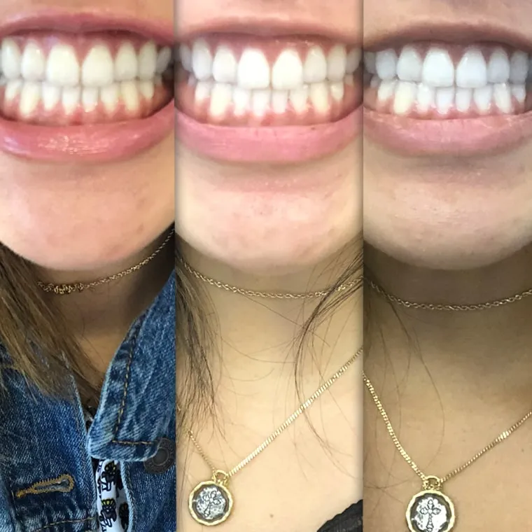 29051 teeth sensitivity