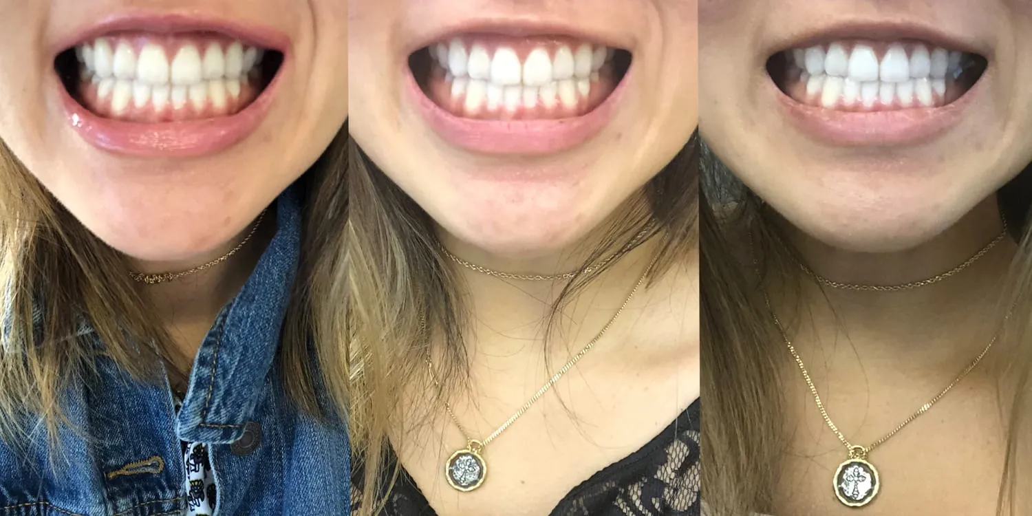 29051 teeth whitening process