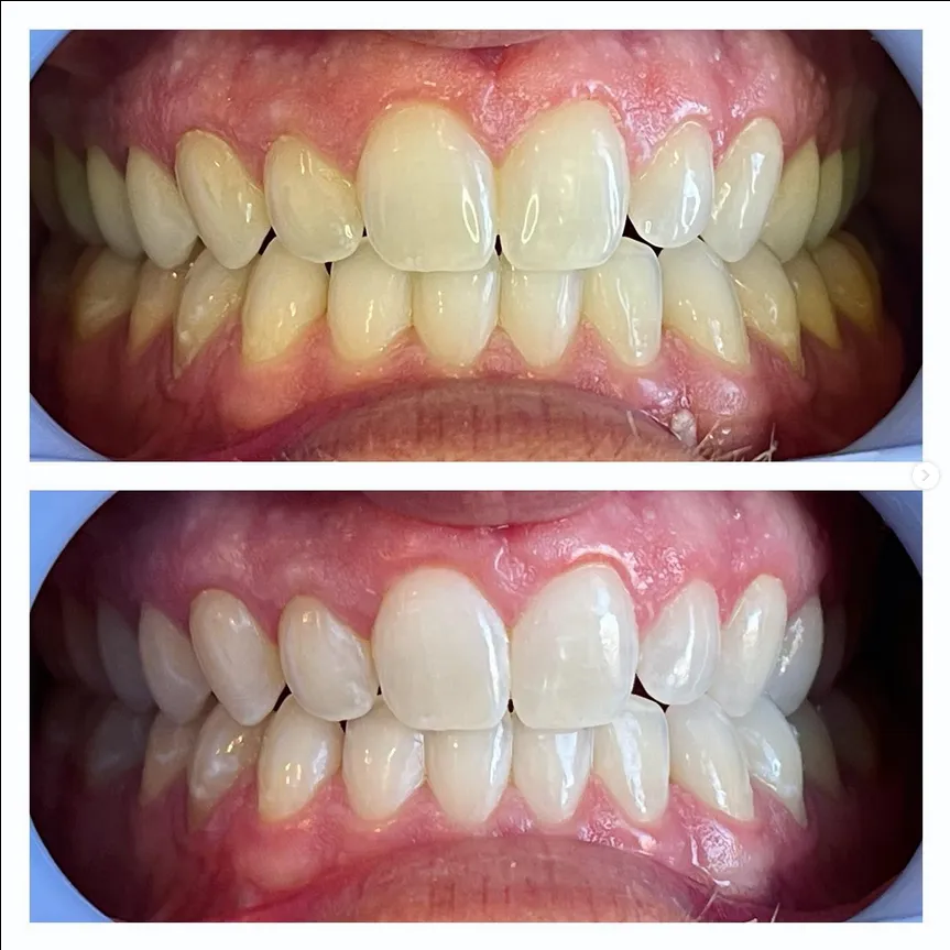 29052 professional teeth whitening
