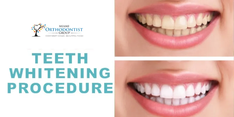 29055 teeth whitening options