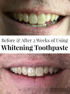 /img/29061-teeth-whitening-gel-smile.webp