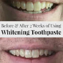 /img/29061-teeth-whitening-gel-smile.webp