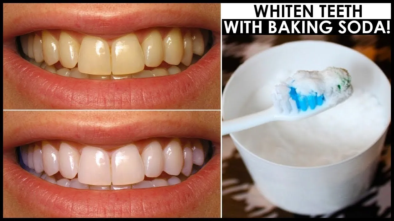 29063 avoiding stains veneers