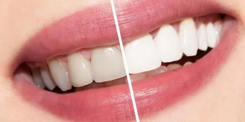 29063 professional whitening