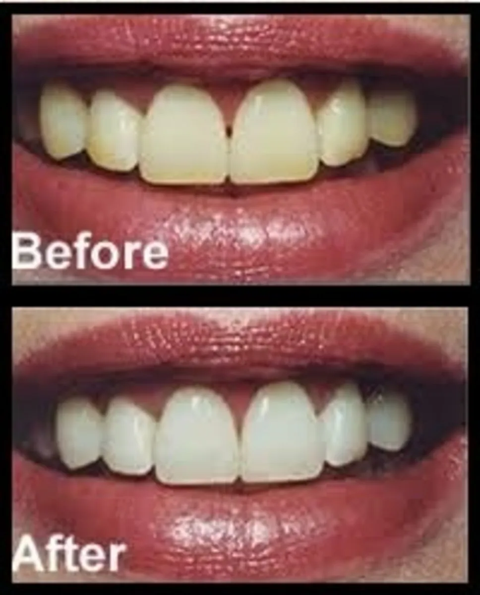 29063 types of veneers