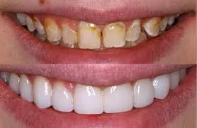 29063 veneers overview