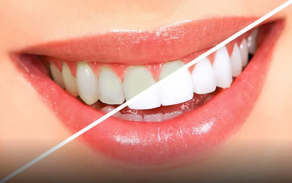 29066 dental clinic teeth whitening