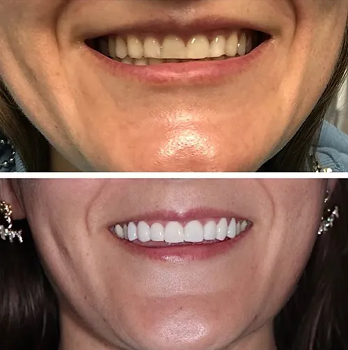 29066 teeth whitening before after