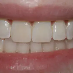 /img/29066-teeth-whitening-spa.webp