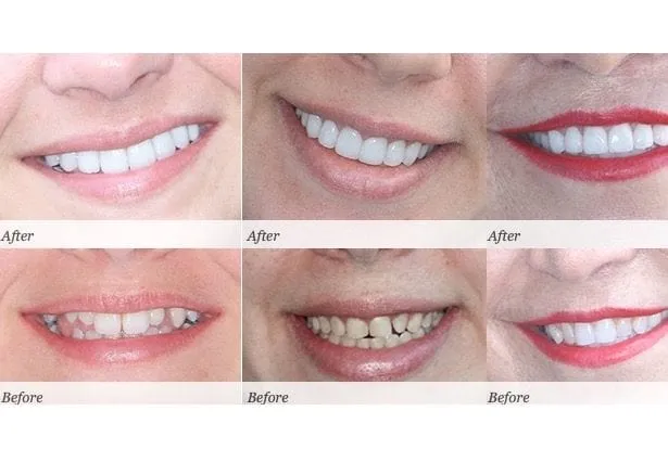 29067 at home teeth whitening