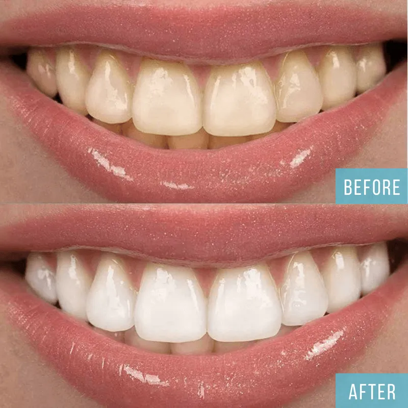 29069 teeth whitening results