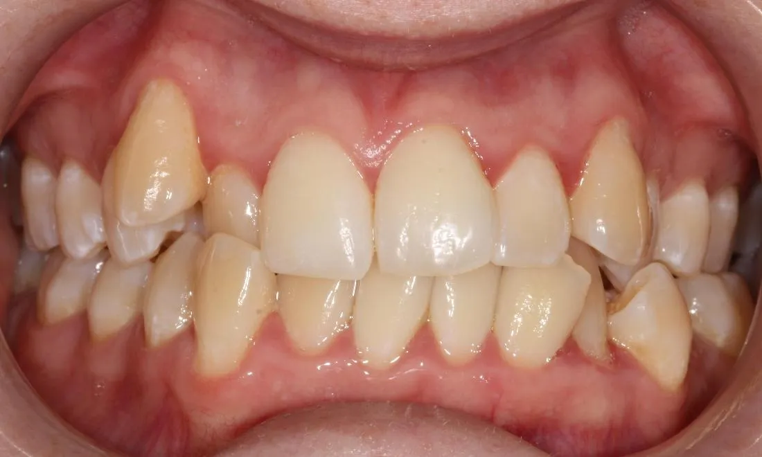 29072 in office teeth whitening