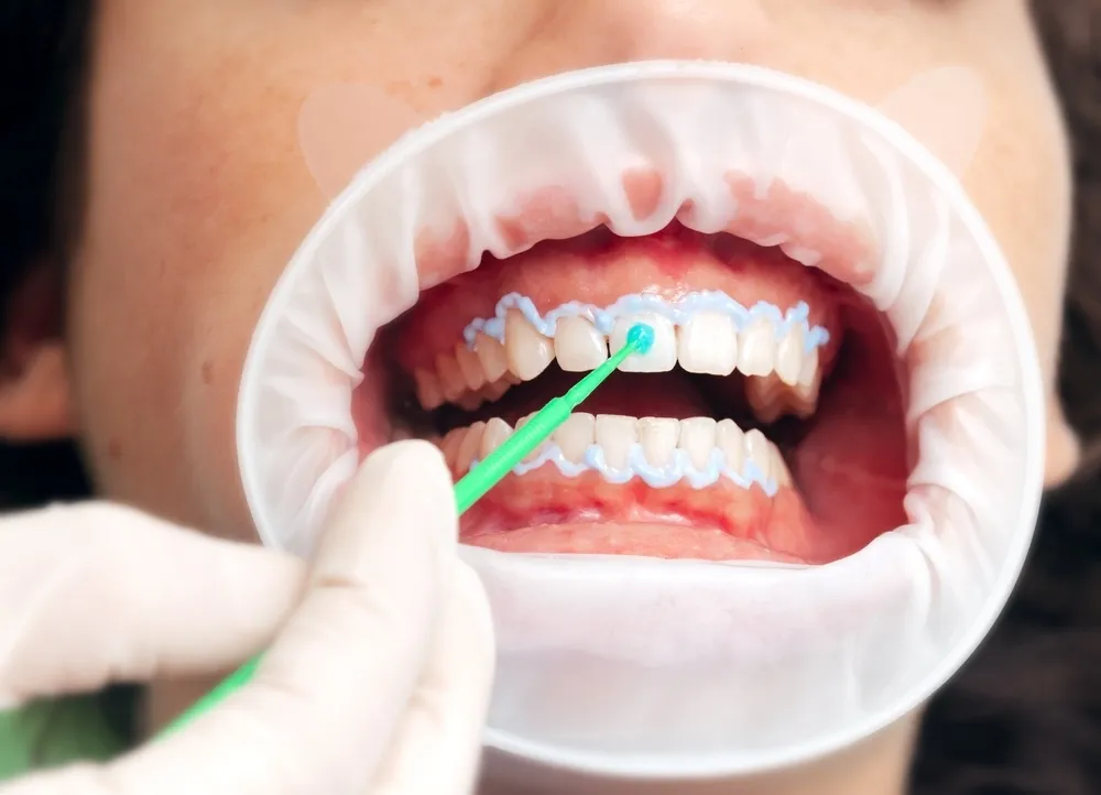 29075 hydrogen peroxide teeth whitening