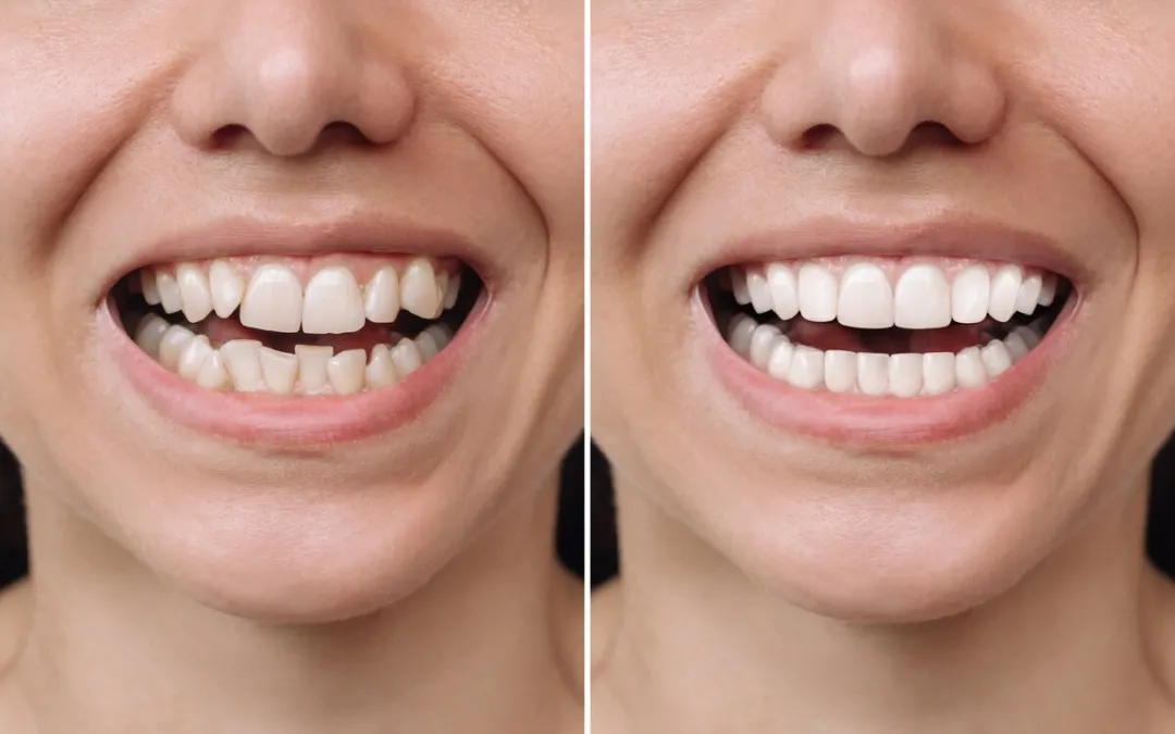 29075 teeth whitening at home
