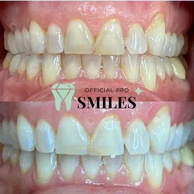 /img/29078-teeth-whitening-chandler-az-confident-smile.webp