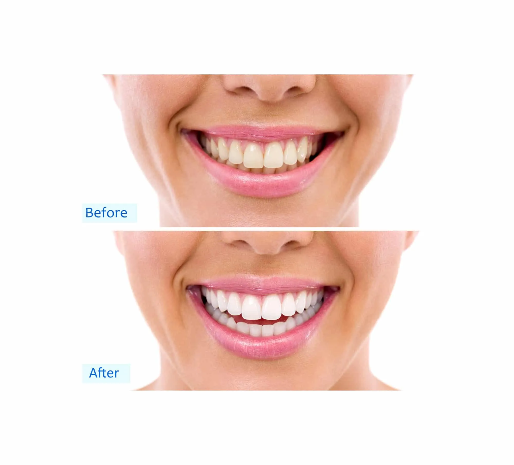 29078 teeth whitening chandler az diet