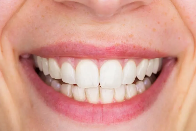 29078 teeth whitening chandler az oral hygiene