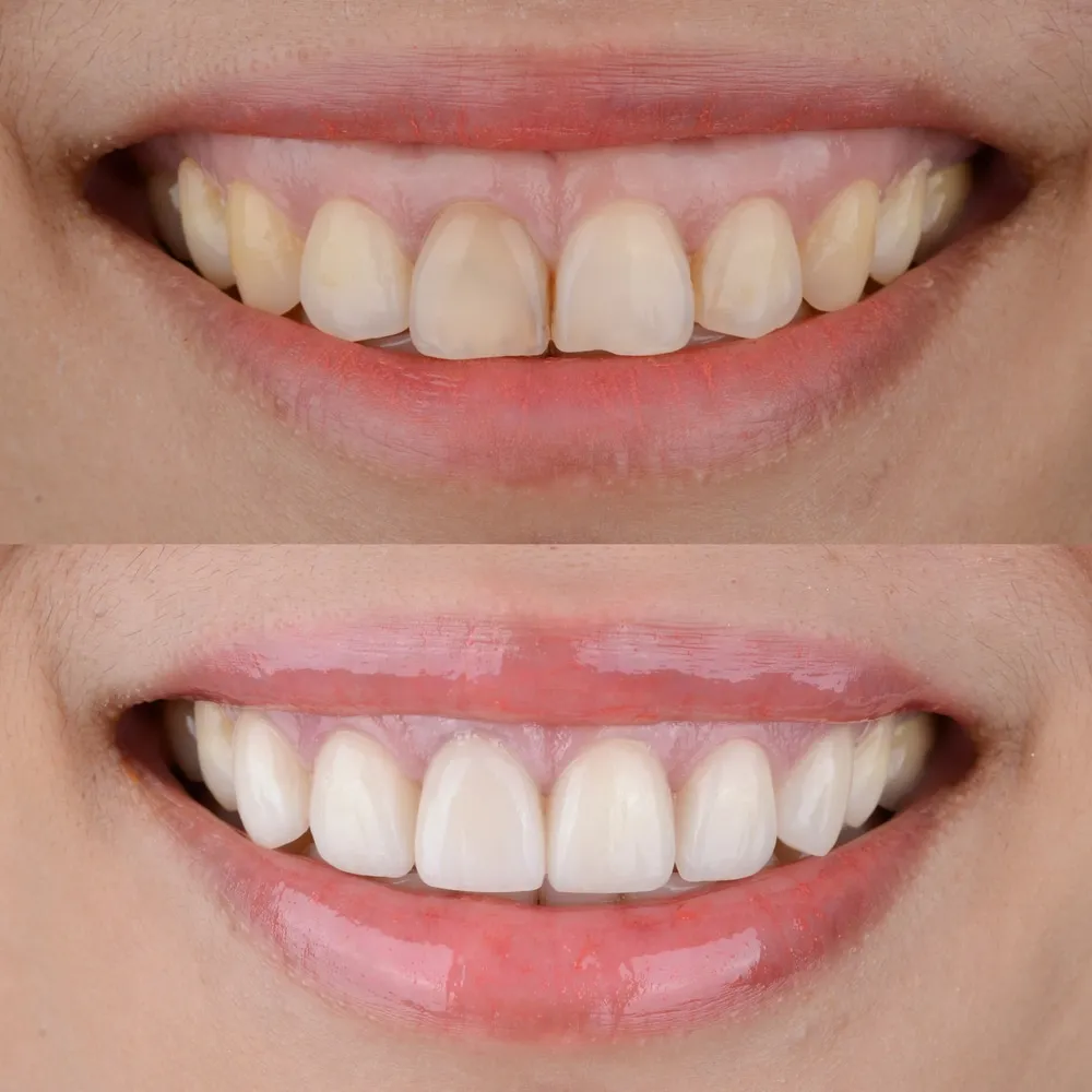 29085 in office whitening procedures