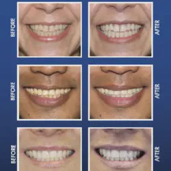 /img/29085-maintaining-white-smile.webp