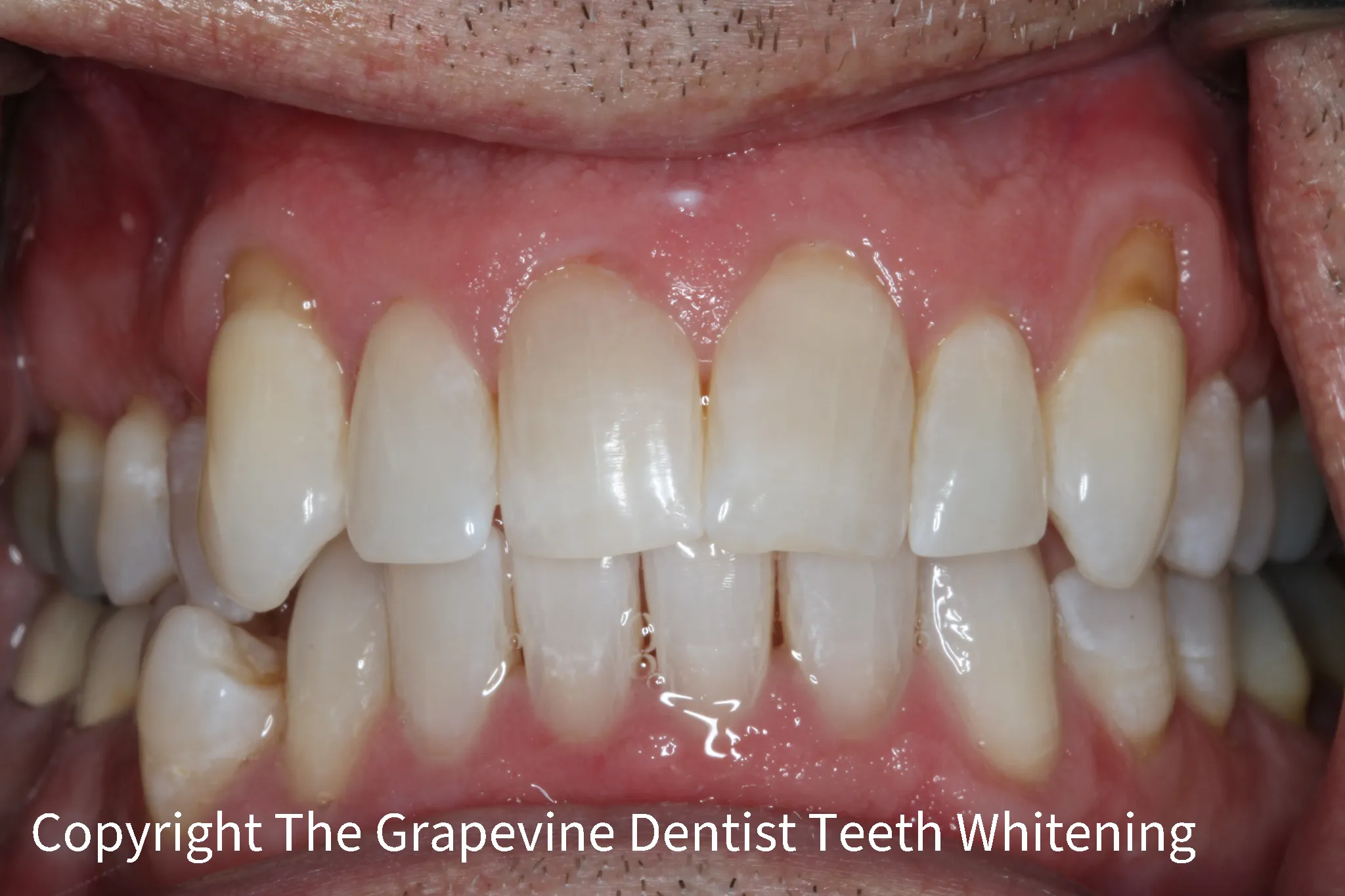 29086 teeth whitening grapevine 1