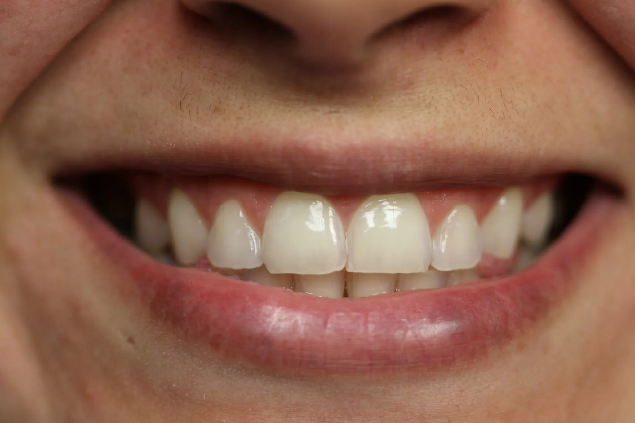 29086 teeth whitening grapevine 3