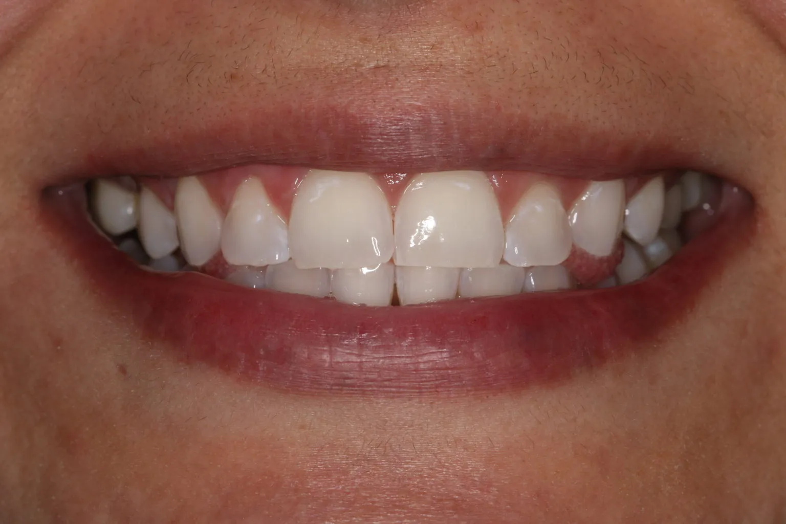 29086 teeth whitening options