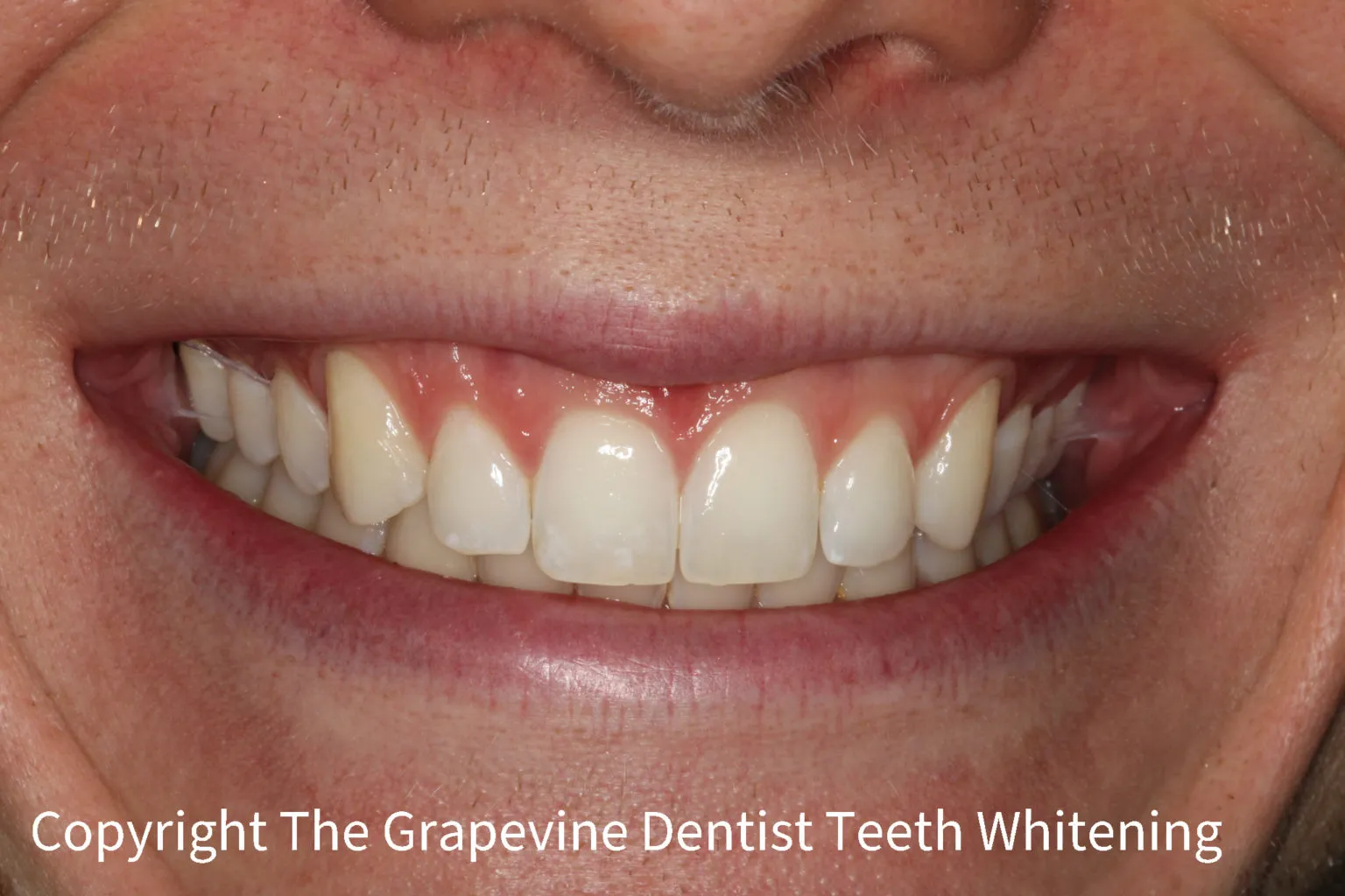 29086 teeth whitening procedure