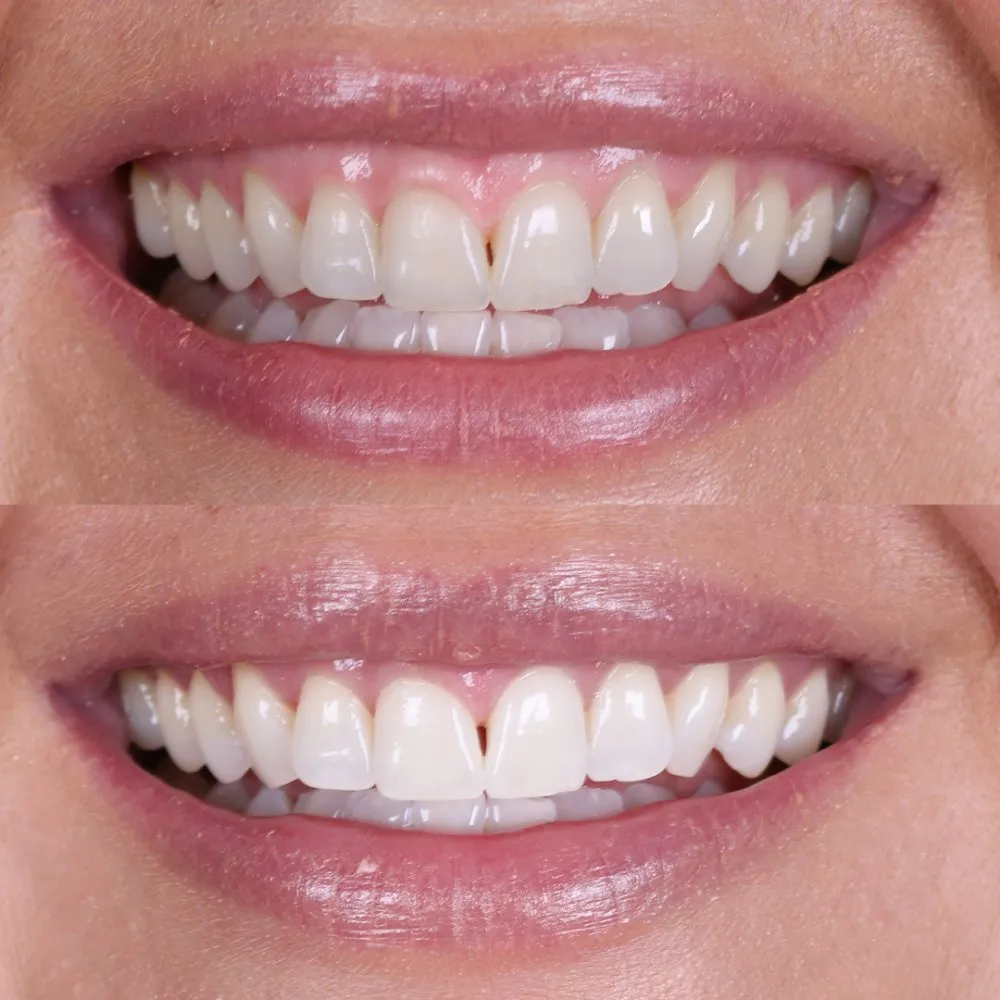 29088 teeth whitening dublin aftercare