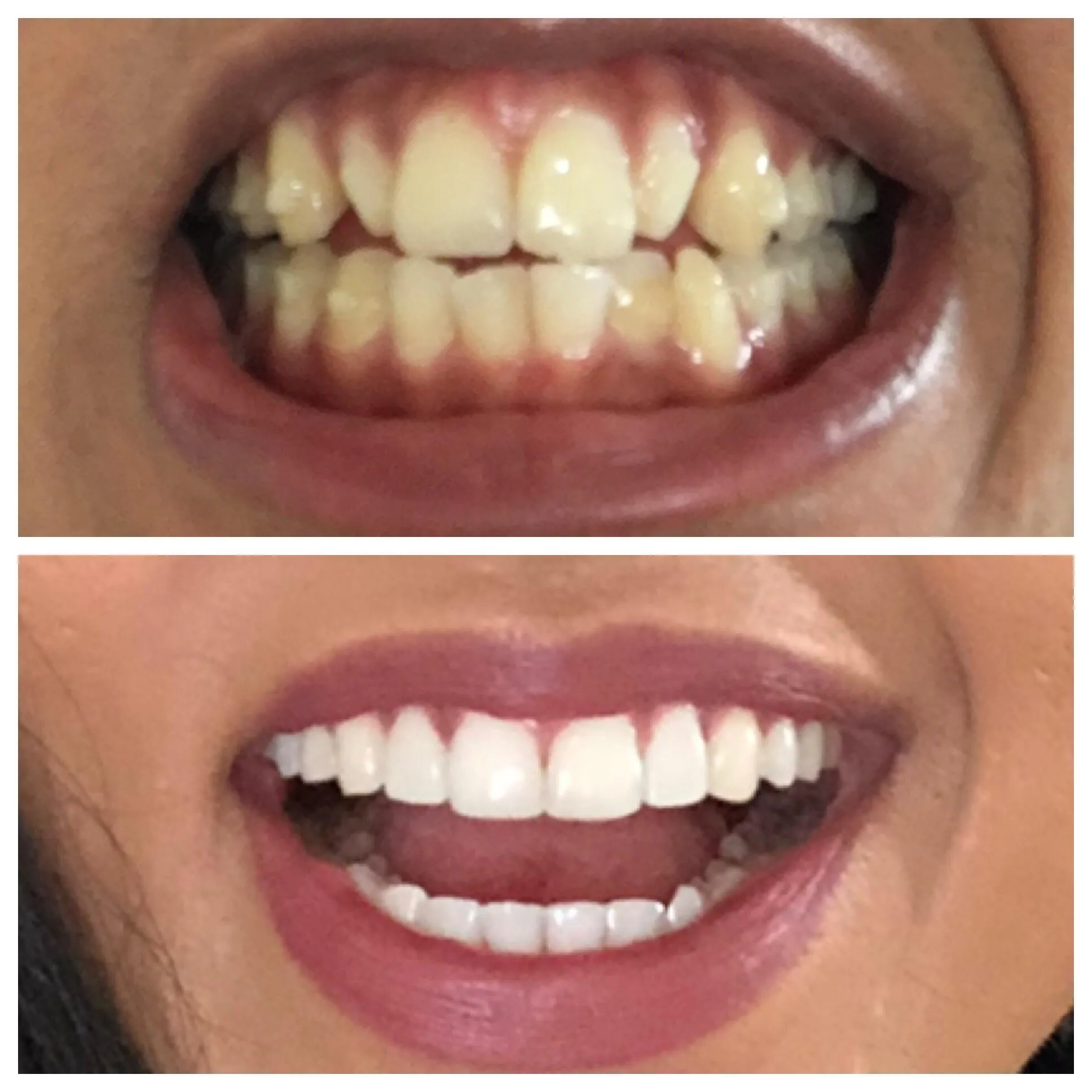 29092 applying whitening strips