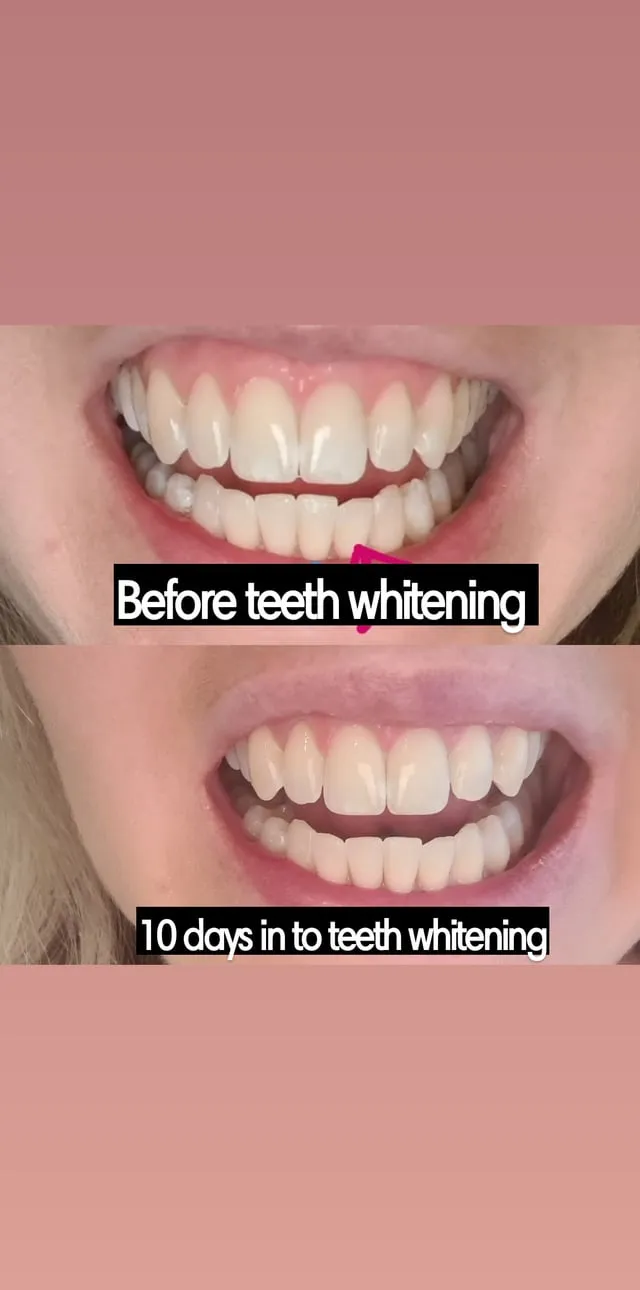 29092 choosing whitening strips