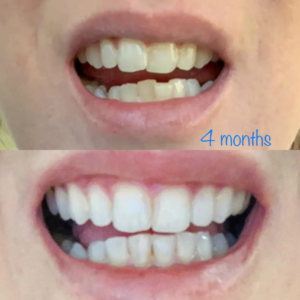 29092 teeth whitening process