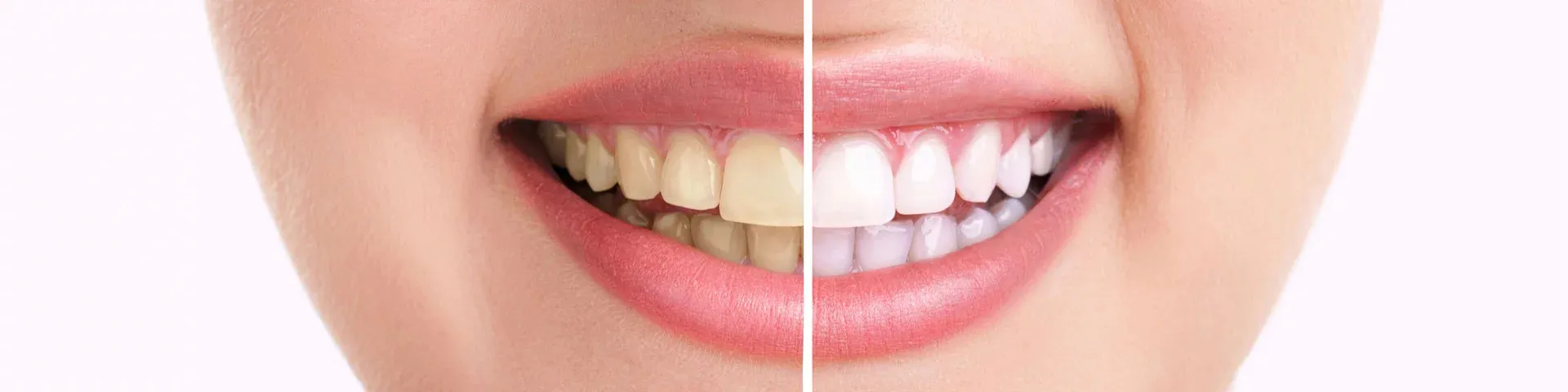 29093 teeth whitening napa overview